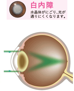 白内障