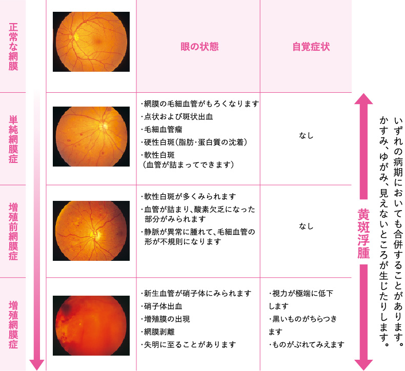糖尿病網膜症の進行段階