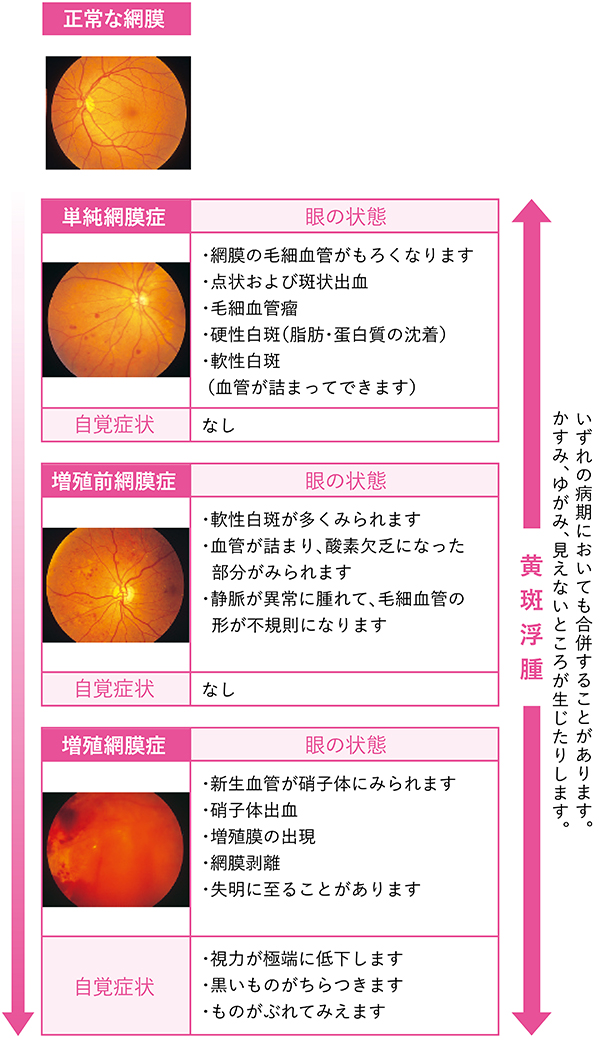 糖尿病網膜症の進行段階(スマホ用)