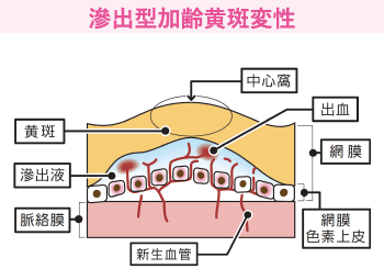 滲出型加齢黄斑変性
