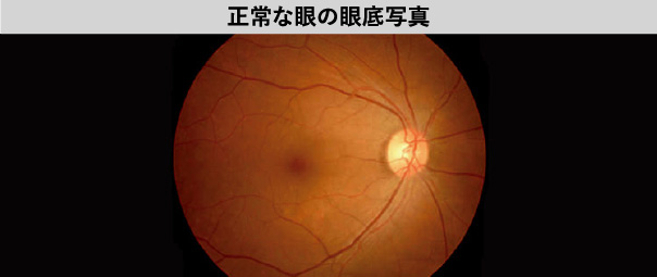 正常な眼の眼底写真