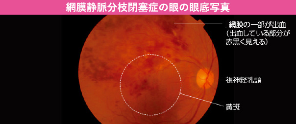 網膜静脈分枝閉塞症の眼の眼底写真