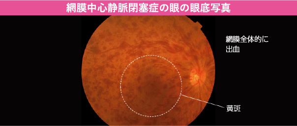 網膜中心静脈閉塞症の眼の眼底写真