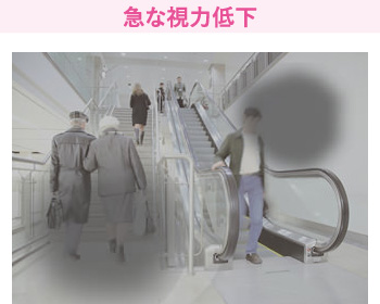 急な視力低下