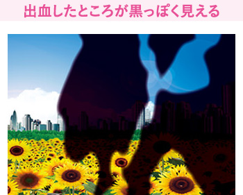 出血したところが黒っぽく見える
