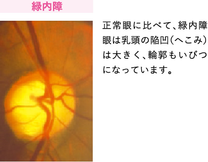 緑内障