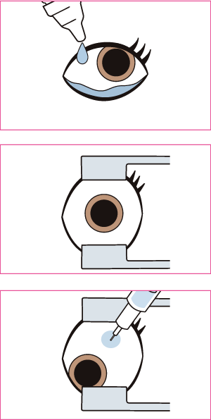 抗VEGF硝子体内注射の方法(図)